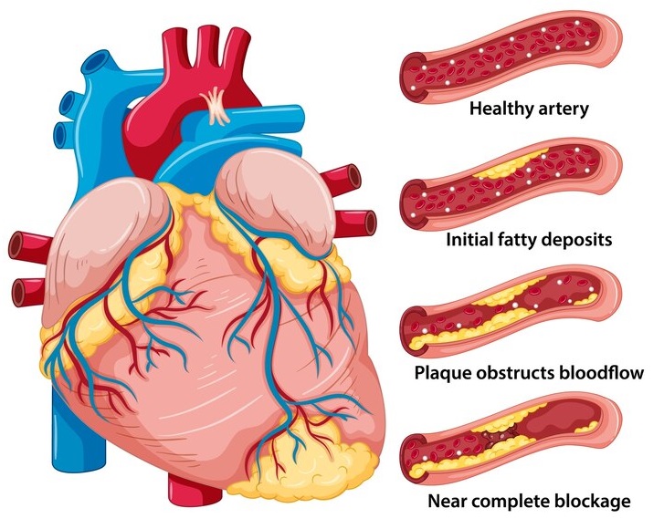 narrowed arteries